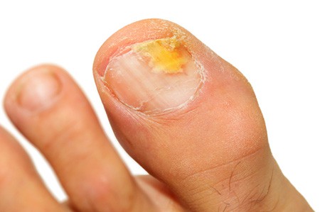 Can I cut off a wart? - Doubleview Podiatry