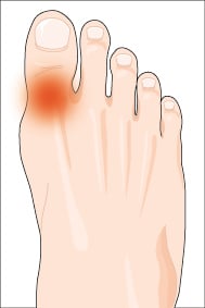 Big toe pain, hallux limitus, hallux rigidus – Hugo Podiatry